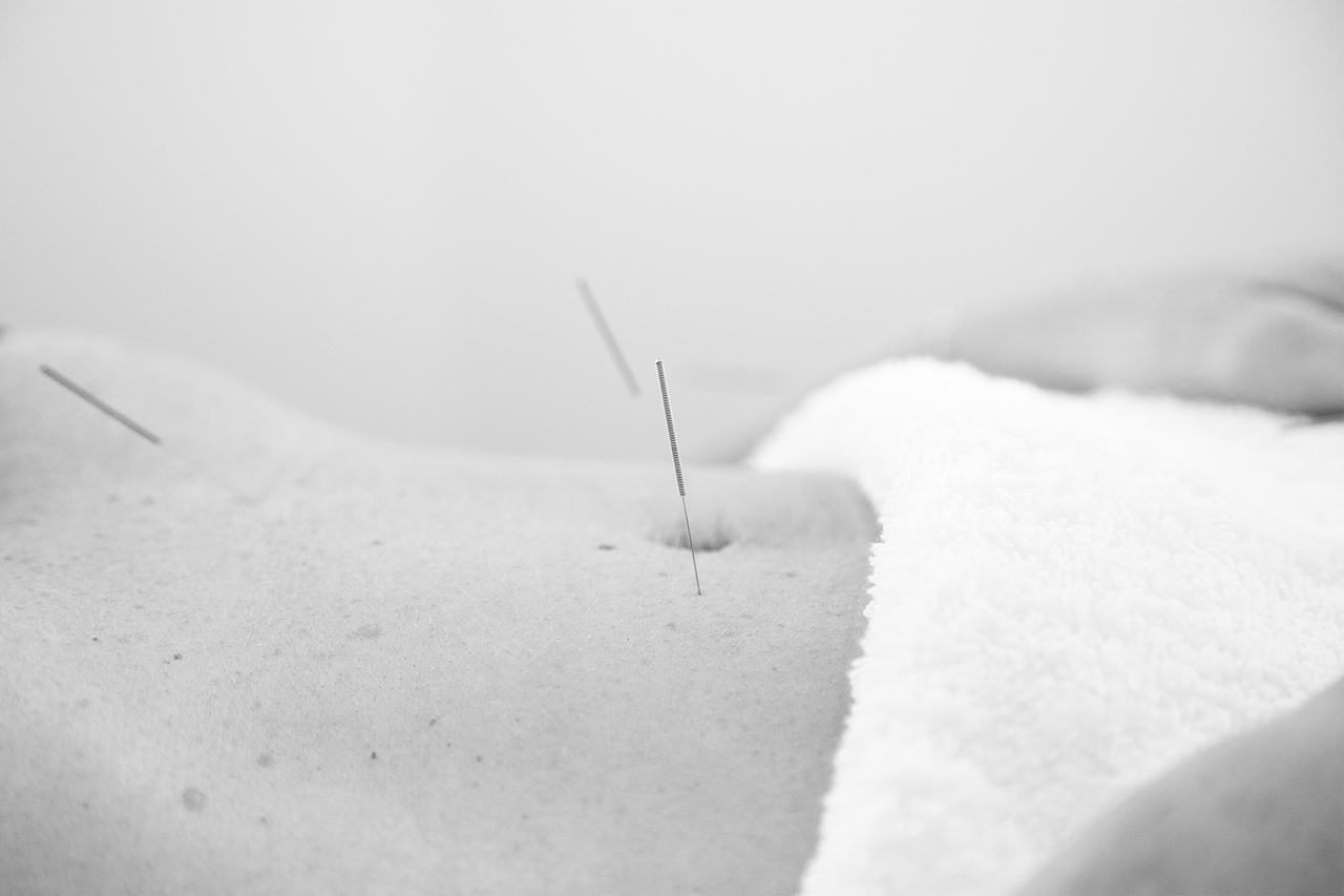 ACUPUNCTURE